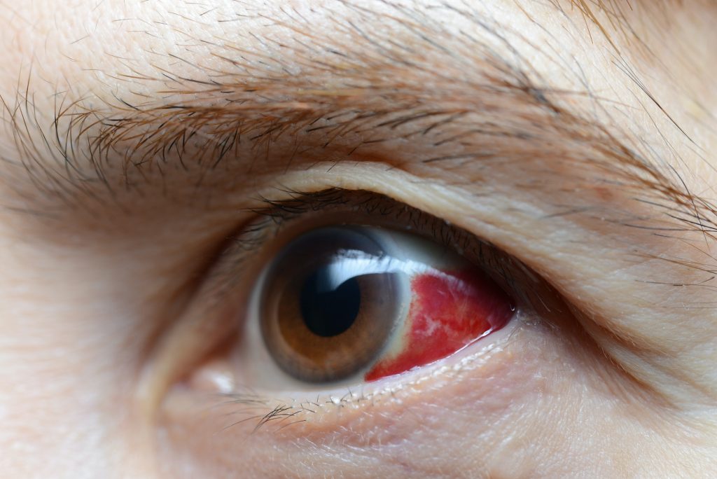 woman with red eye